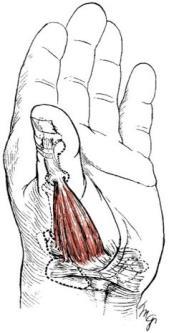 medianus) Ganglion(Sinovyal Kist): Çoğunlukla el bileğinin dorsal kısmında, en çok bayanlarda görülen ve genellikle ağrı yapmayan şikinliklerdir. Eğer o bölgede sinir sıkışıyorsa ağrıya yol açabilir.