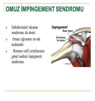 İmpingment (sıkışma)sendromu: Omuzdaki çoğu ağrıların nedeni omuzdaki bursitis ve kolun abduction u esnasında rotator cuff kas tendonlarının acromion altında (bilhassa m.