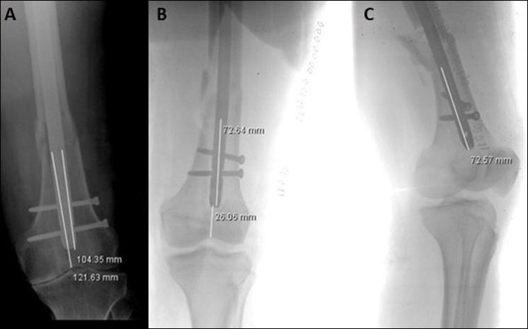 Femur Distal Diafiz Kırıklarının Tedavisi Şekil 2. (a) Direkt grafide çivi-eklem mesafesi (ÇEM) ve kırık-çivi mesafesi (KÇM) ölçümleri. (b) Direkt grafide kırıkçivi mesafesi (KÇM) ölçümü.