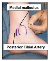 Posterior Tibial sinir stimülasyonu PT sinirden elektirik uyarı S2-S4