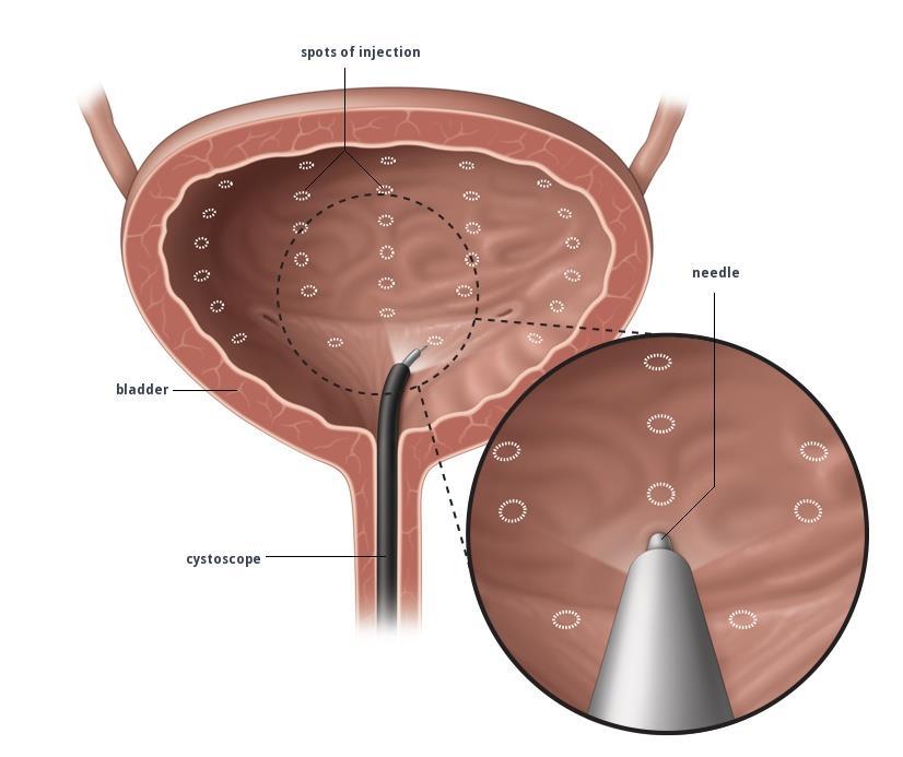 Botulinum