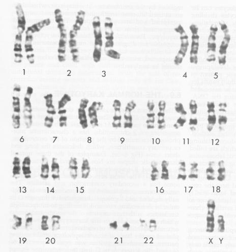 Sitogenetik Değerlendirme ve Moleküler Testler Sitogenetik incelemede kemik iliği hücrelerindeki kromozomlar incelenir.
