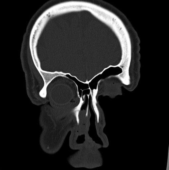 Olgunun çekilen paranazal sinüs bilgisayarlı tomografi (BT) sinde sağ nazal kavite anterior kesiminde kemik yapıda destrüksiyona neden olmayan sağ inferior nazal konka ve komşu kavite duvarından