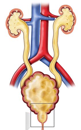 VI. Üriner Sistemin Değerlendirmesi Konjenital (PUV, spina bifida, Prune Belly sendromu, VUR, mesane ekstrofisi vs) ya da