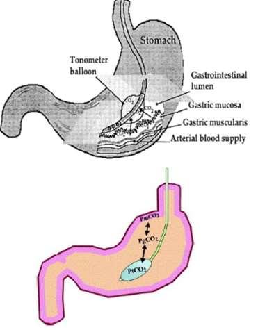 Gastrik Tonometri GİS hipoperfüzyona çok