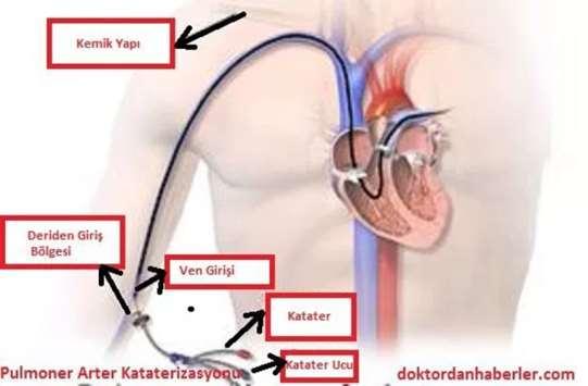 Pulmoner Arter Kateterizasyonu Kalbe yeterli kan gelip gelmediği Kalbin periferik ve pulmoner yatağına yeterli kanı