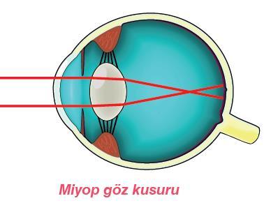 Miyop Göz Kusuru (Uzağı Net Görememe): Yakını iyi