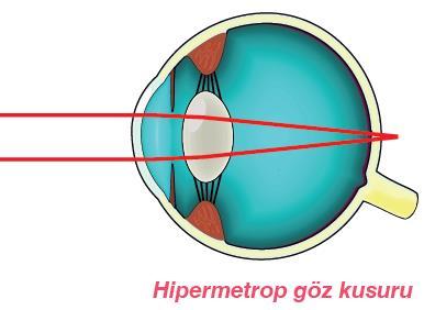 Hipermetrop Göz Kusuru (Yakını Net Görememe): uzağı iyi