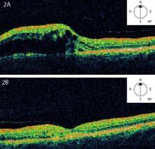 ödem olduğu görüldü. (C) Tedaviden 6 ay sonra bu bölgedeki retinal ödemin gerilediği, hemorajilerin kaybolduğu ve lazer spotlarının olduğu görüldü.