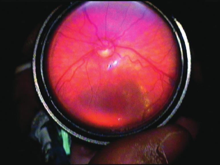 26 Prematüre Retinopatisi Tedavisi: 2014 Yılı Sonuçlarımız GİRİŞ Prematüre retinopatisi, prematüre infantlarda görülen ve retinanın kan damarlarını etkileyen bir hastalıktır.