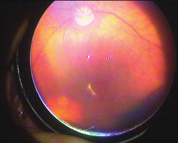 Prematüre retinopatisi genellikle yüksek oksijen konsantrasyonlarına maruz kalmış düşük doğum ağırlıklı ve erken doğan bebekleri etkileyen bir proliferatif vitreo-retinopatidir.