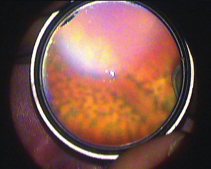 ROP gelişiminin altında yatan temel neden, doğumda retina vaskülarizasyonunun tamamlanmamasıdır. Bunun sonucunda patolojik retina ve damar gelişimi ortaya çıkar.