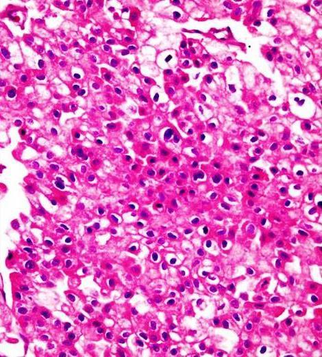 moderate differentiated epidermoid carcinoma. When RCCs were examined from statistical aspect, no statistically significant relationship was determined between diagnosis, Figure 3.