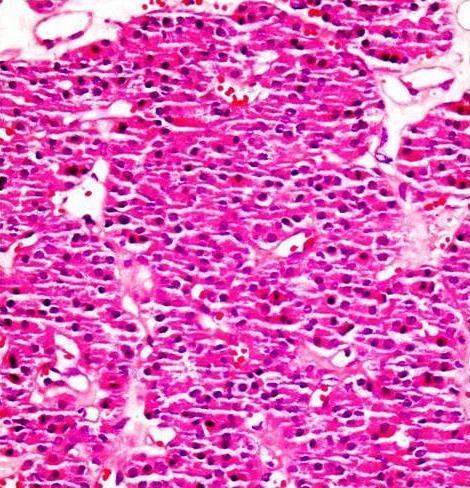 irregular border, HEx100 nuclear grade, and tumor diameter (p>0.05). 50% of papillary RCC cases and 46.