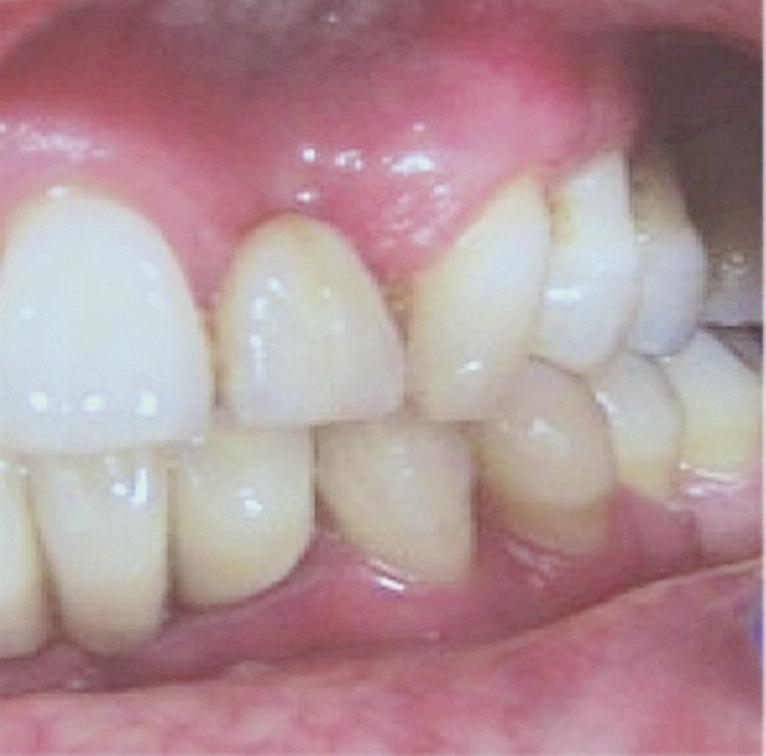 Büyükhatipoğlu et al. RESİM 2: FGK tedavisi sonrası. üzerindeki dental plak, politür işlemi yapılarak uzaklaştırıldı ve çalışma alanının izolasyonu için dudak ekartörü ve pamuk rulolar yerleştirildi.