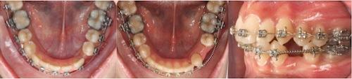 56 ÖZER ALKAN-YEŞİM KAYA-BETÜL YÜZBAŞIOĞLU Angle Sınıf I molar ilişki elde edilinceye kadar servikal headgear kullanılarak üst molar dişlerin distalizasyonu yapılmıştır.