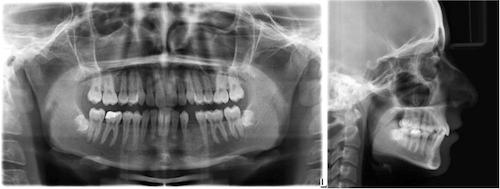 Sabit ortodontik tedavi sonrasında ise mandibular sol birinci premolar dişin kökünde rezorpsiyon benzeri herhangi bir patolojik durumun meydana gelmediği görülmüştür (Resim 7).