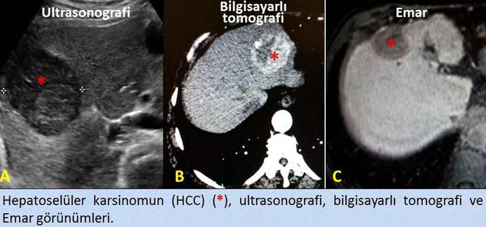 MALİGNİTE Hepatit