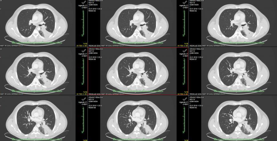 Olgu (M.intrasellülare) BT de sol hiler 10x20 sağ akciğerde alt lob 15x20 mm konsolide alan sağ aksillada 9x12 mm lam EBUS yapılmış.