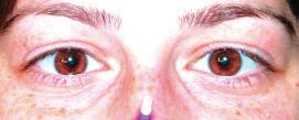 Dilate edilmifl olan pupillalardan solda bifokal kontakt lensin opti i