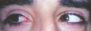 u hastalarda vertikal rektus transpozisyonu veya göz küresinin iç kantal ligamana fiksasyonu denenebilecek yöntemlerdir (Resim 11-70).