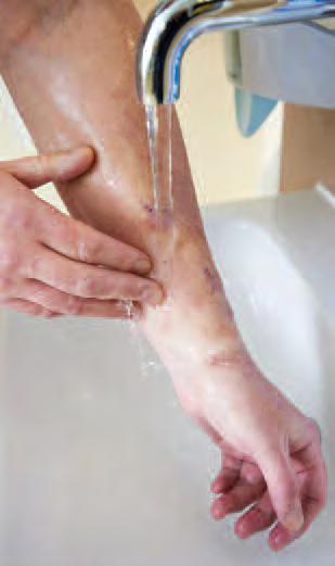 AV Fistüller ve Greftler için; Diyaliz tedavisi başlamadan önce, hastaların damar ulaşım yolunu/kolunu antibakteriyel sabun, fırça/ su ile yıkanmasını sağlatın, 4.