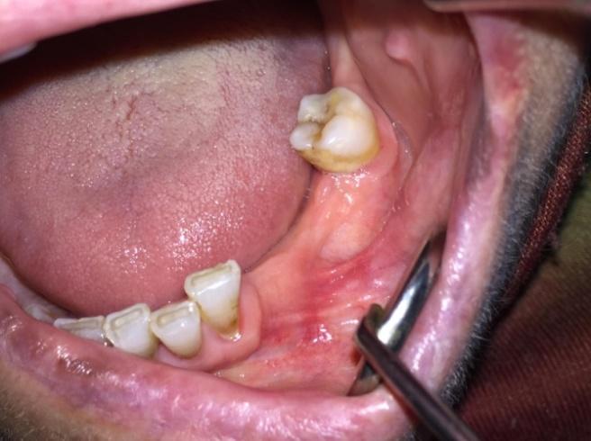 (resim 10) Hastanın çürük olan dişlerinin dolguları yapılıp oral hijyen eğitimi