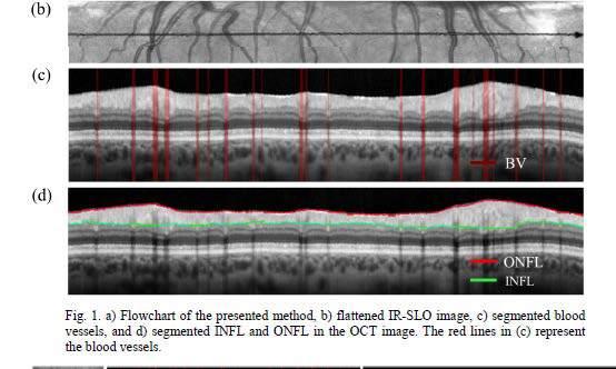 Ağır MS (j,k,l) İç retinal tabakaların
