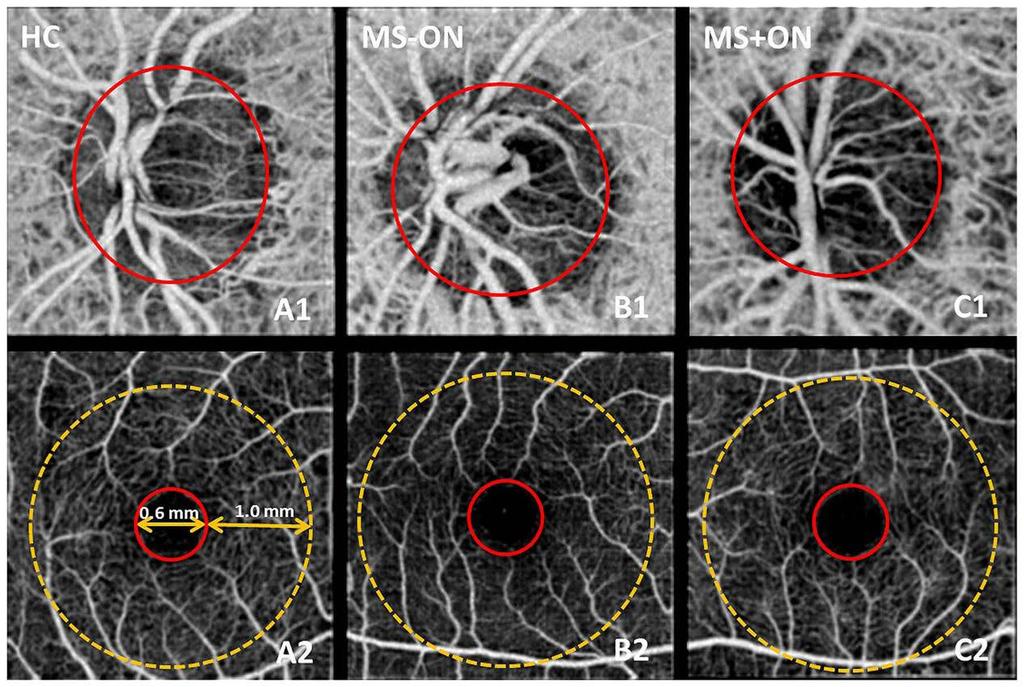 Optical coherence tomography angiography of optic nerve head and parafovea in multiple sclerosis Wang X, Jia Y, Spain R et al. Br J Ophthalmol. 2014 ; 98(10): 1368 1373.