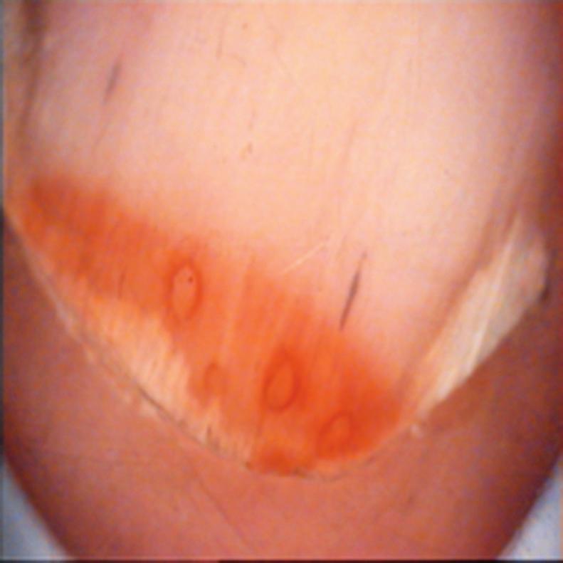 121 the most common additional findings were longitudinal striations (62.5%) and capillary prominence at the onychodermal band (67.5%). The other common additional clinical findings were horizontal striations (7.