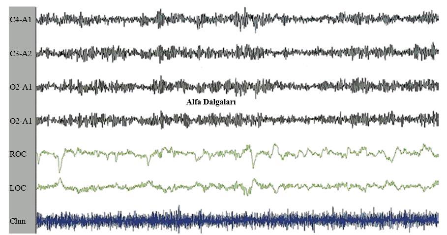 Oksipital bölgeden alınan kayıttan elde edilen epoğun %50 si alfa dalgası ise epok uyanık olarak etiketlenir. 2.