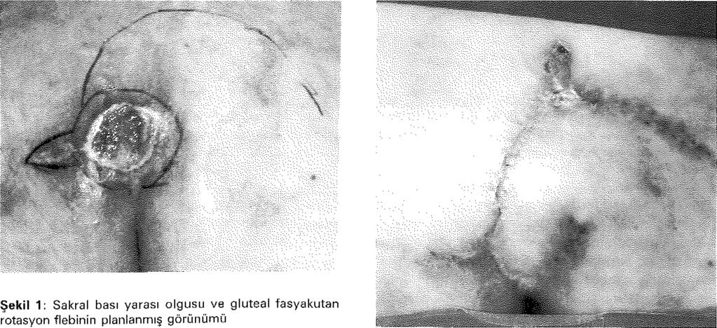 Yüksekten düşme 29 26 Disk herniasyonu 4 4 Ateşli silah yaralanması 3 3 Transvers myelit 3 3 Toplam 94 85 En çok kullanılan cerrahi tedavi seçeneklerini; sakral bölgede; gluteal fasyakutan flepler