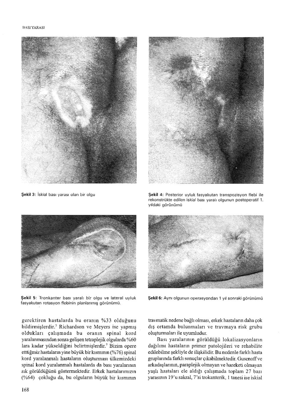 BASI YARASI Şekil 3: iskial bası yarası oian bir olgu Şekil 4: Posterior uyluk fasyakutan transpozisyon flebi ile rekonstrükte edilen iskîal bası yaratı olgunun postoperatif