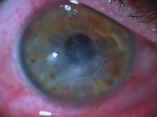 05 düzeyindeydi, her iki göz kornea ülserinin boyutlar nda küçülme gözlemlendi ve hastaya bilateral silikon hidrojel bandaj kontakt lens uyguland.