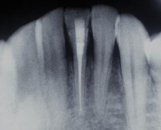 Dentin aşındırılması sırasında pulpa boynuzunun açığa çıkmasıyla, ilgili dişin kanal tedavisi planlandı. Diş rubber dam ile izole edildikten sonra endodontik kavite açıldı.