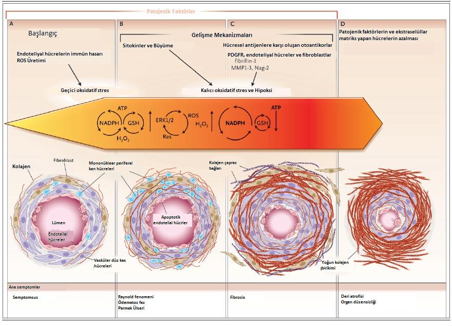 7 Şekil 1.1. Sklerodermanın Farklı Evrelerinde Oluşan Hasar (Gabrielli ve ark, 2009) Endotel hücre hasarının skleroderm gelişmesinde önemli rol aldığı düşünülmektedir.