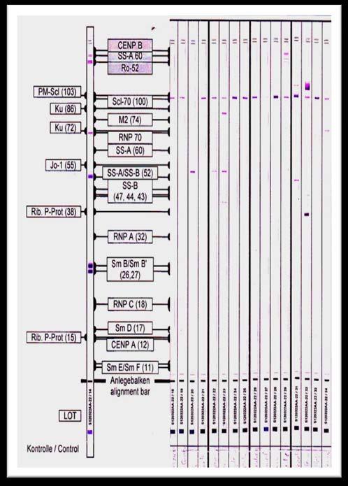 54 SSc lu 93 hastada Scl-70 ELISA yöntemi için Roc Curve analizi yapıldı. Bu yöntemde eğri altındaki alan (AUC) 0.954, P=0.