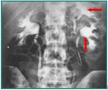 1.4. Böbreğin Damarları Resim 1.11: Pyelogramda solda çift böbrek Böbrekleri yerinde tutan en önemli oluģumlardan biri olan a. renalisler 1. ve 2.