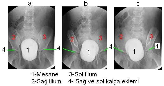 Retrograd Sistografide Anatomik Yapı Mesaneye direkt olarak kontrast madde verilerek kontrast madde ile doldurulan mesanenin