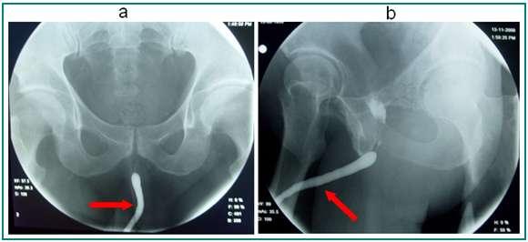 Retrograd Üretrografide Anatomik Yapı Erkek üretrasını değerlendirmek amacı ile üretraya direkt kontrast madde verilerek yapılan