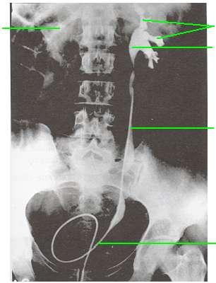 Retrograd pyelogramda (retrograd ürogram)anatomik