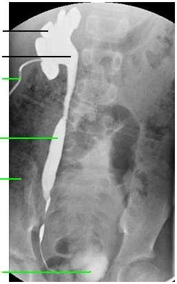 radyogramı Antegrad pyelogramda anatomik  radyogramı