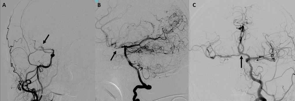 Resim 4. Serebral Anjiyogramlarda intrakraniyal kollateraller görülmektedir(oklar).