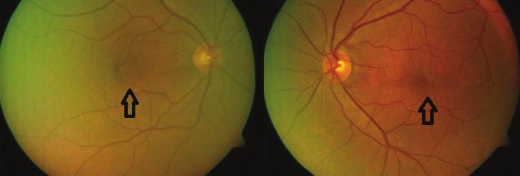 3). FOF görüntülemede, sağ gözde perifoveal bölgede halkasal hiperotofloresans, sol gözde foveada hiperotofloresans, perifoveal bölgede pigmenter değişikliklerle uyumlu noktasal hipotofloresans