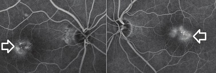 Resim 7: Olgu 2, sağ ve sol fundus florosein anjiografi, beyaz oklar iki taraflı perifoveal hiperfloresans ve telenjiektazileri Resim 8: Olgu 2, beyaz oklar sağ ve sol fundus otofloresans