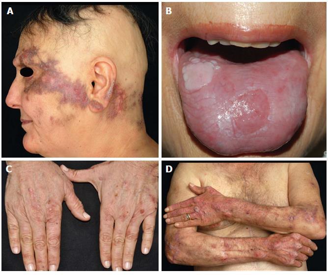 HCV ve Dermatolojik Bulgular Kutanöz Lichen planus Erosif