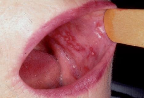 Dermatolojik hastalıklar Lichen planus Tekrarlayan kaşıntılı