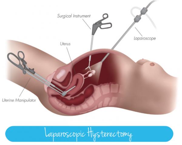 1- MAKALELERDEN SEÇMELER Myoma Uterisi Olan 40 Yaş Üzeri Kadınlarda, Laparoskopik Myomektomi ile Total Laparoskopik Histerektominin İlk 30 Günlük Komplikasyon Oranlarının Karşılaştırılması Sheyn D,