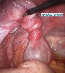 ADNEXAL MASSES ENCOUNTERED DURİNG CESAREAN DELİVERY BASER AE, ERKİLİNC AS, ESİN BS, TOGRUL AC, BİBEROGLU AE, KARACA MZ, GUNGOR AT, DANİSMAN N INTERNATİONAL JOURNAL OF GYNECOLOGY AND OBSTETRİCS 123