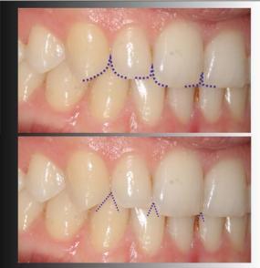 21 Foulger ve arkadaşları 61 diş hekimleri, hastalar ve dental teknisyenler arasında yaptıkları bir çalışmada embrajür boşlukların yetersizliğinin gülme estetiğini önemli ölçüde olumsuz etkilediğini